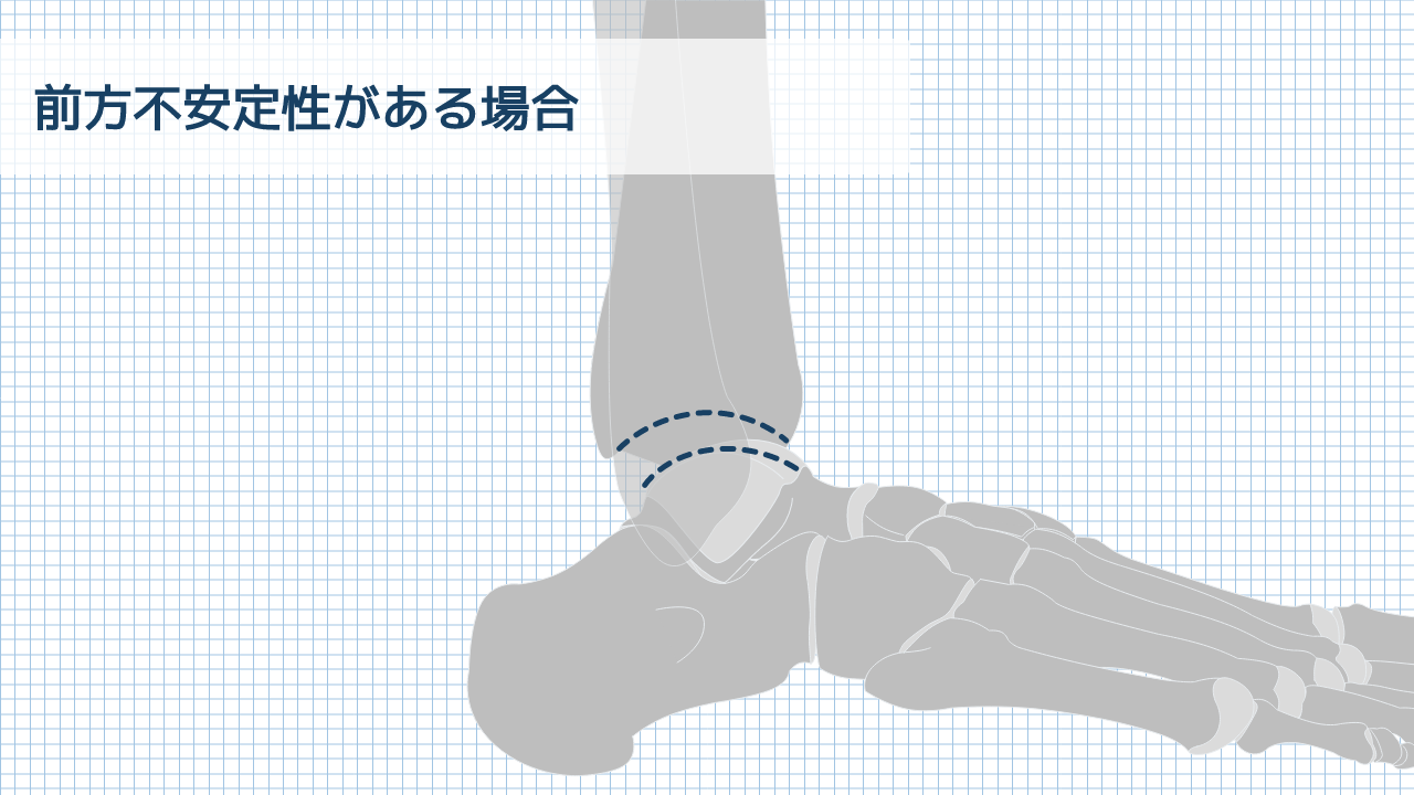 【運動器リハのすゝめ】足部・足関節のレントゲン所見の見方