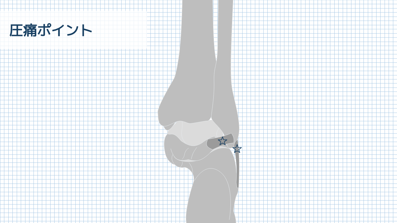 【運動器リハのすゝめ】足部・足関節の圧痛検査