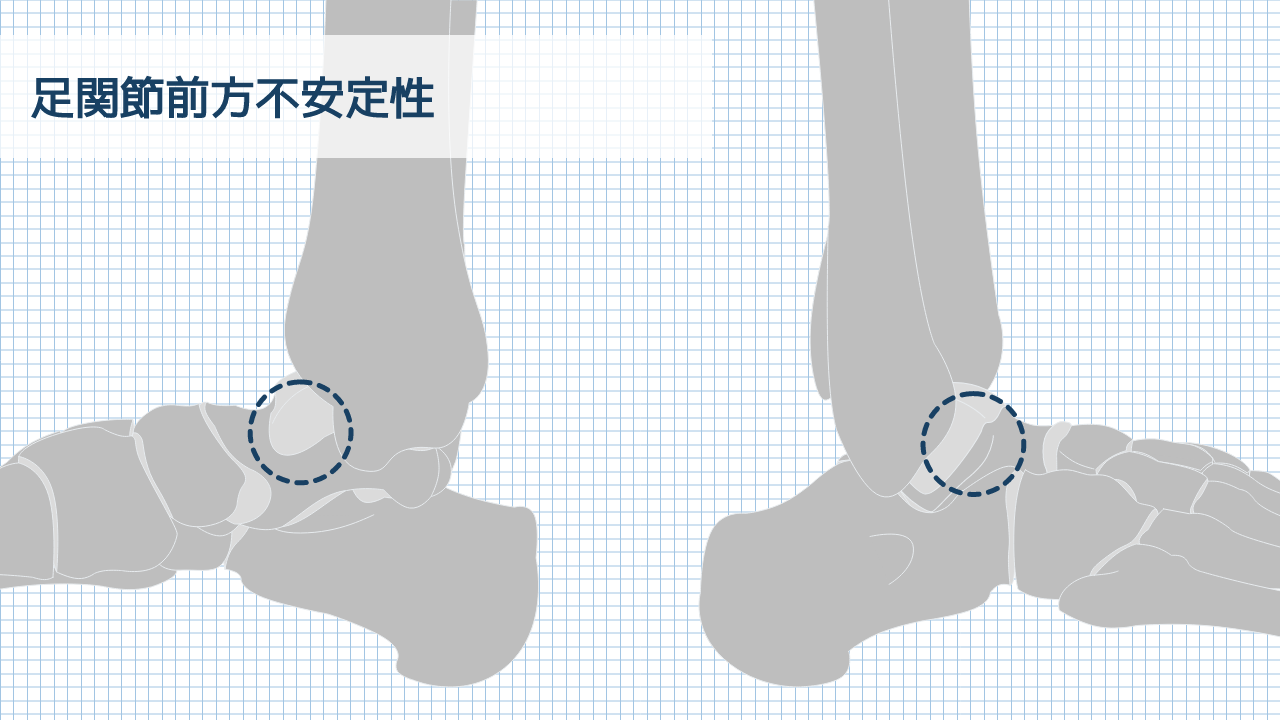 【運動器リハのすゝめ】足部・足関節の関節不安定性テスト