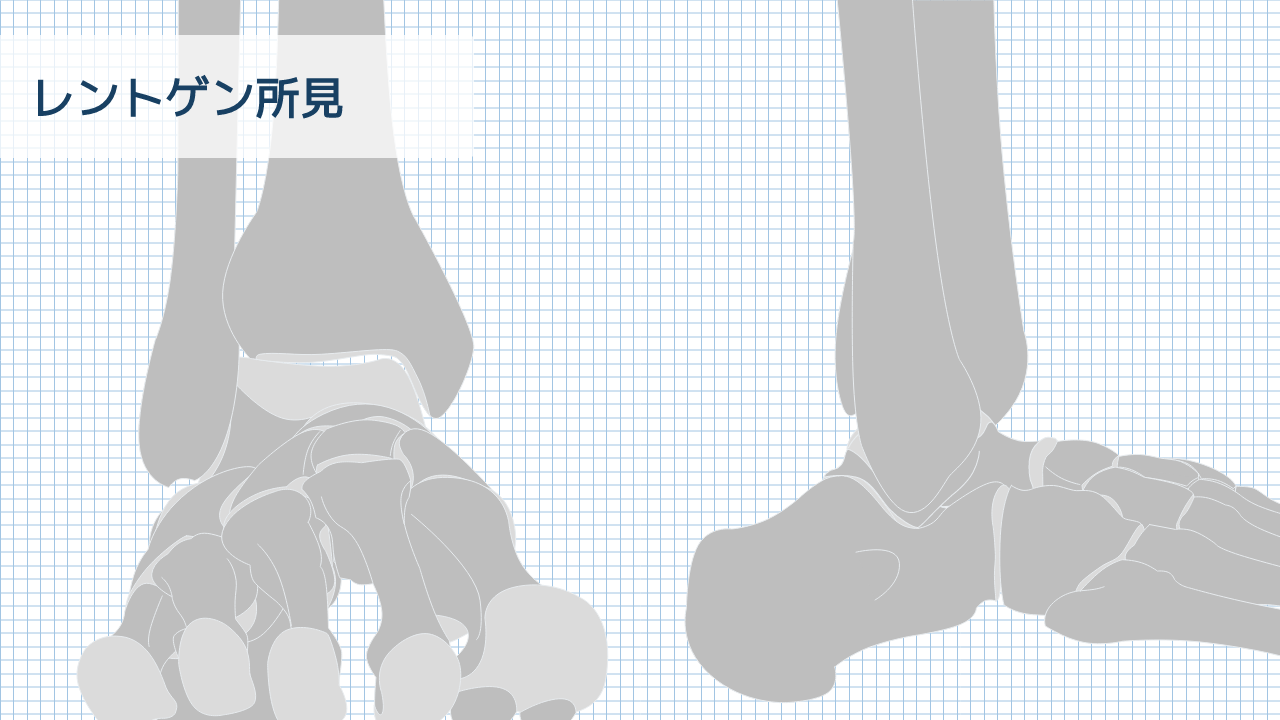 【運動器リハのすゝめ】足部・足関節のレントゲン所見の見方